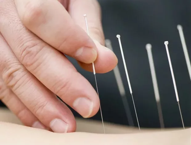 Grosse-nationale-Studie-untersucht-die-Wirksamkeit-von-Akupunktur-bei-Schmerzmanagement