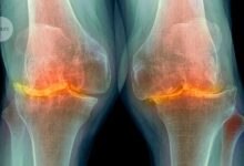 Anti-obesity drug has life-changing benefits for arthritis