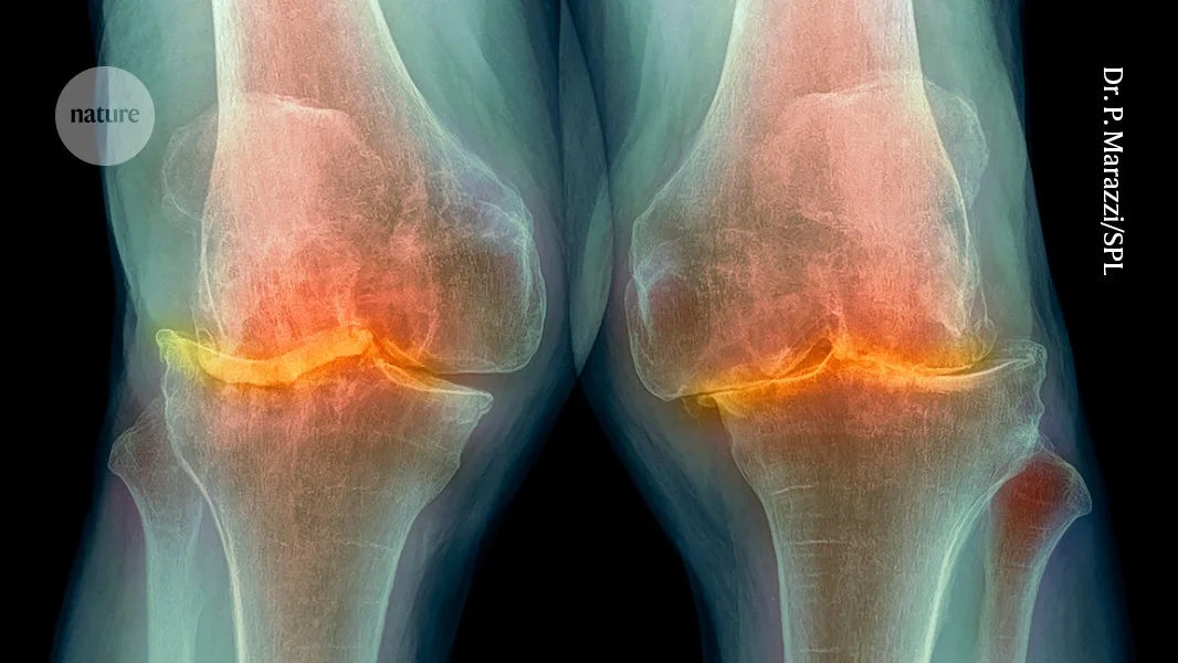 Anti-obesity drug has life-changing benefits for arthritis